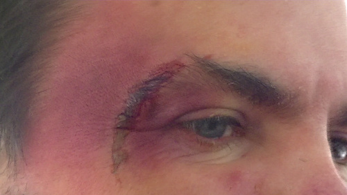 Blunt Trauma