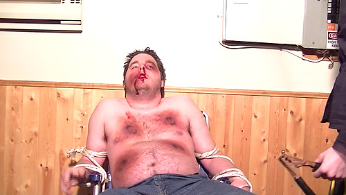 Bruising and Electrical Burns